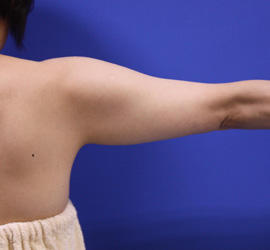 40代女性の脂肪吸引 Before 症例写真