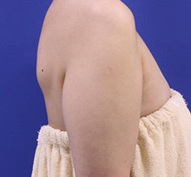 40代女性の脂肪吸引 Before 症例写真