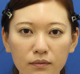 30代女性の3Dリポアイリフト  After 症例写真