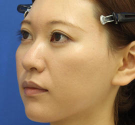 30代女性の3Dリポアイリフト  After 症例写真