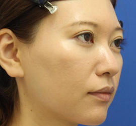 30代女性の3Dリポアイリフト  After 症例写真