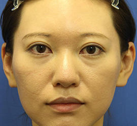 30代女性の3Dリポアイリフト  Before 症例写真