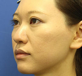 30代女性の3Dリポアイリフト  Before 症例写真