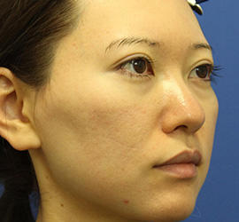 30代女性の3Dリポアイリフト  Before 症例写真