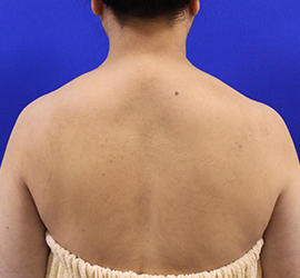 50代女性のボトックス（美肩・肩こり解消） After 症例写真