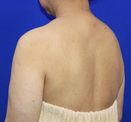 50代女性のボトックス（美肩・肩こり解消） After 症例写真