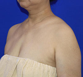 50代女性のボトックス(美肩・肩こり解消) After 症例写真