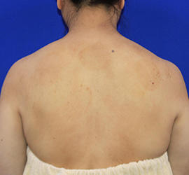 50代女性のボトックス（美肩・肩こり解消） Before 症例写真