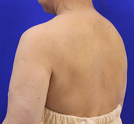 50代女性のボトックス（美肩・肩こり解消） Before 症例写真