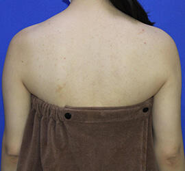 20代女性の脂肪吸引 After 症例写真