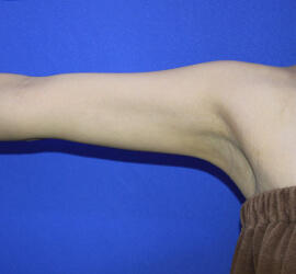 20代女性の脂肪吸引 After 症例写真