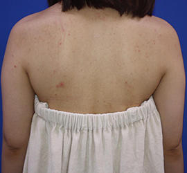 20代女性の脂肪吸引 Before 症例写真