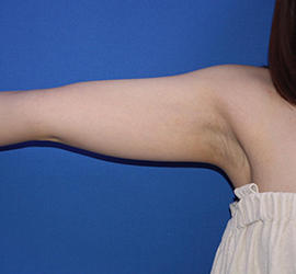 20代女性の脂肪吸引 Before 症例写真