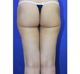 20代女性の脂肪吸引 After 症例写真