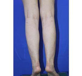 20代女性の脂肪吸引 After 症例写真