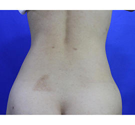 20代女性の脂肪吸引 After 症例写真