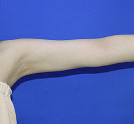 20代女性の脂肪吸引 After 症例写真