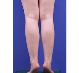 20代女性の脂肪吸引 Before 症例写真