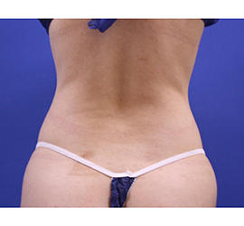 20代女性の脂肪吸引 Before 症例写真