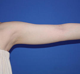 20代女性の脂肪吸引 Before 症例写真