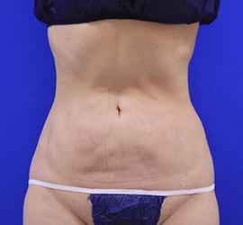 50代女性の脂肪吸引 After 症例写真