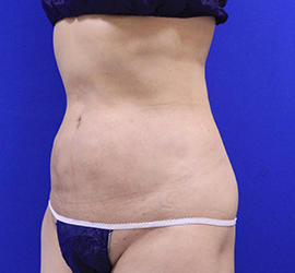 50代女性の脂肪吸引 After 症例写真