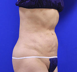 50代女性の脂肪吸引 After 症例写真