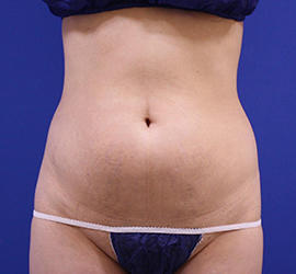 50代女性の脂肪吸引 Before 症例写真