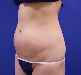 50代女性の脂肪吸引 Before 症例写真