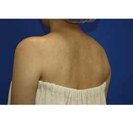 30代女性のボトックス（美肩・肩こり解消） After 症例写真