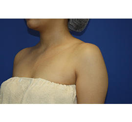 30代女性のボトックス（美肩・肩こり解消） After 症例写真