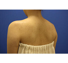 30代女性のボトックス（美肩・肩こり解消） Before 症例写真