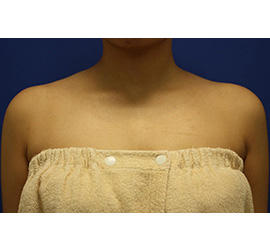 30代女性のボトックス（美肩・肩こり解消） Before 症例写真