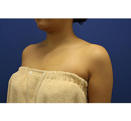 30代女性のボトックス（美肩・肩こり解消） Before 症例写真