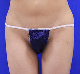 20代女性の脂肪吸引 After 症例写真