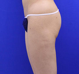 20代女性の脂肪吸引 After 症例写真