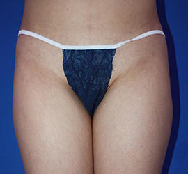 20代女性の脂肪吸引 Before 症例写真