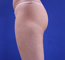 20代女性の脂肪吸引 Before 症例写真