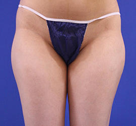 20代女性の脂肪吸引 Before 症例写真