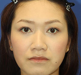 30代女性の目の下の脱脂  After 症例写真