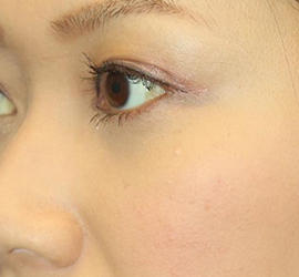 30代女性の目の下の脱脂 After 症例写真