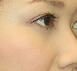 30代女性の目の下の脱脂  After 症例写真