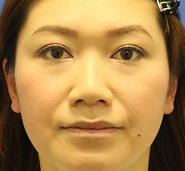 30代女性の目の下の脱脂  Before 症例写真