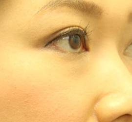 30代女性の目の下の脱脂  Before 症例写真