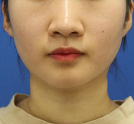 20代女性の顔の脂肪吸引  After 症例写真