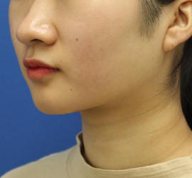 20代女性の顔の脂肪吸引  After 症例写真