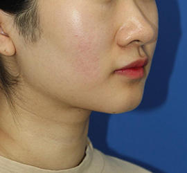 20代女性の顔の脂肪吸引  After 症例写真