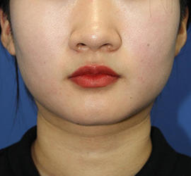 20代女性の顔の脂肪吸引  Before 症例写真