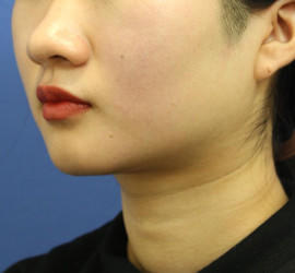 20代女性の顔の脂肪吸引  Before 症例写真