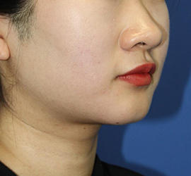 20代女性の顔の脂肪吸引  Before 症例写真